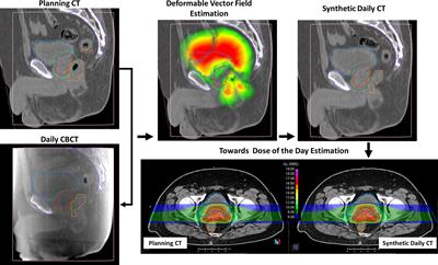 Dosimetric Impact of Inter-Fraction Anatomical Changes in Carbon Ion Boost Treatment for High-Risk Prostate Cancer (AIRC IG 14300)